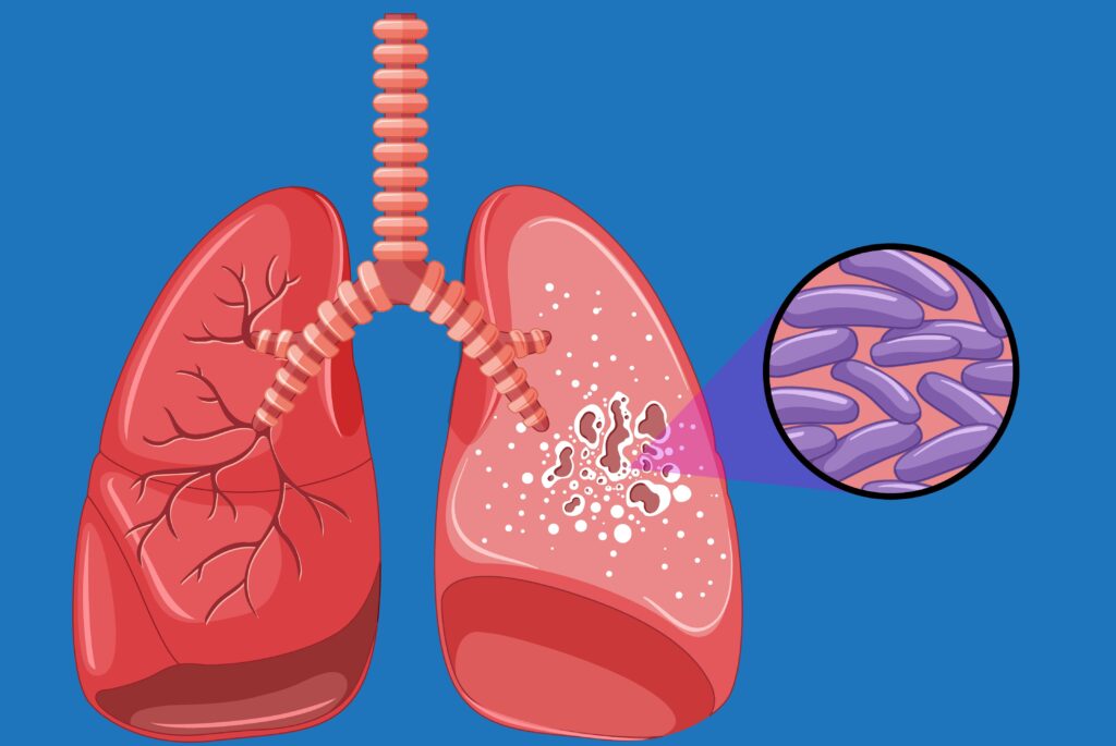 Tuberculosis